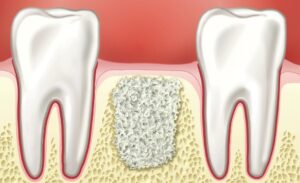 Чем отличается открытый и закрытый синус-лифтинг?
