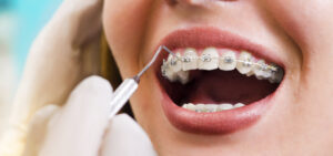 Для чего нужны брекеты?