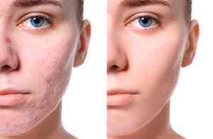 Лечение постакне: популярные методы