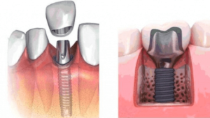 Можно ли ставить временные коронки на импланты?