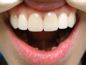 Виды металлокерамических коронок