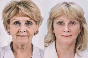 Бьютификация - подтяжка, пластика и омоложение лица