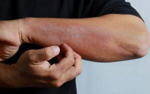 Атопический дерматит: причины, симптомы и методы лечения