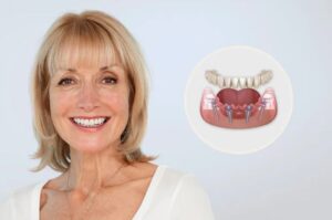 All-on-4: как четыре имплантата могут вернуть вам улыбку и полноценное жевание