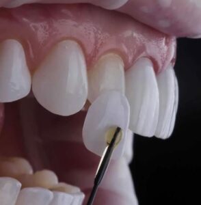 Виниры из полевошпатной керамики: плюсы и особенности