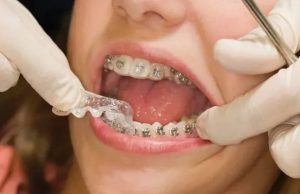 Как ставят брекеты?